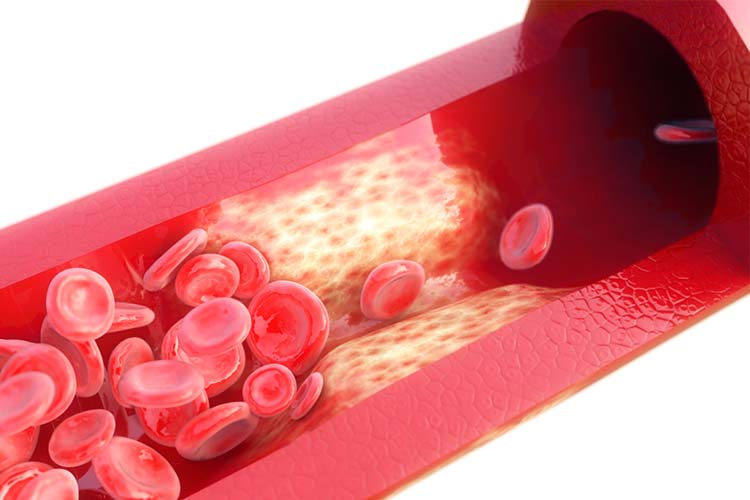 脂質異常症とは